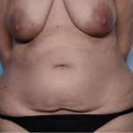 Tummy Tuck Before & After Patient #34291